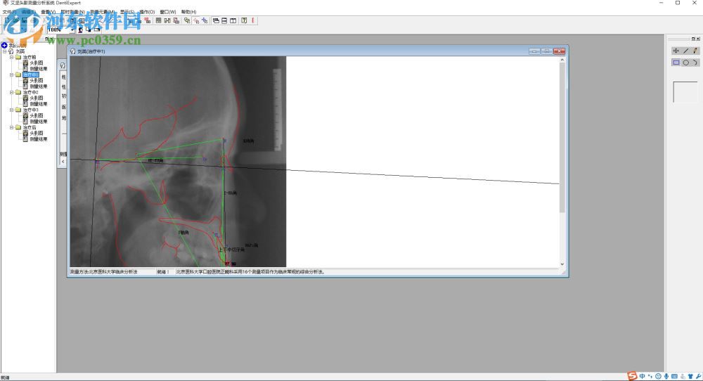 艾堅頭影測量分析系統(tǒng)下載(DentiExpert) 2.2 官方版