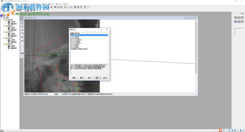 艾堅頭影測量分析系統(tǒng)下載(DentiExpert) 2.2 官方版